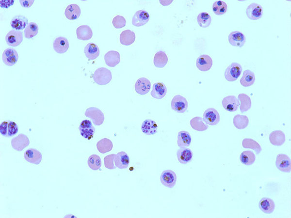 Pfalciparum Malaria