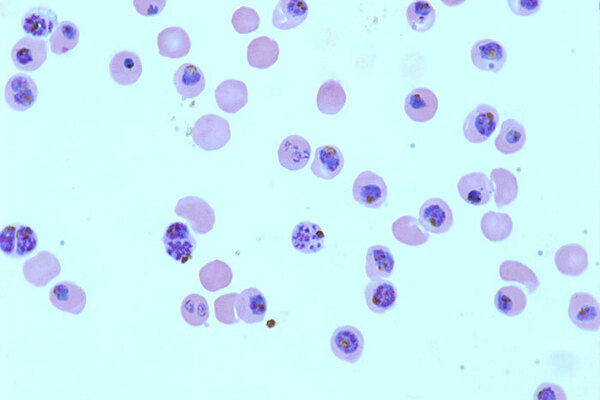 P falciparum Malaria viewed under microscope